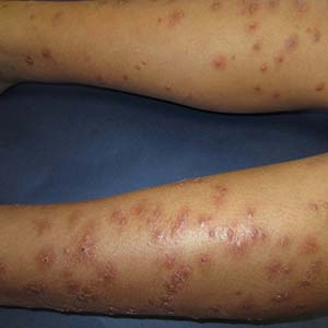 “Kids Bee-Ware! All the Buzz About Bug Bites and Stings” (Don’t Be Rash: The Pediatric Dermatology Podcast: 2025, Ep. 3)