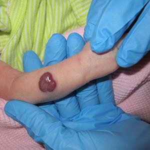 “Red Alert! Hemangiomas and Port Wine Birthmarks” (Don’t Be Rash: The Pediatric Dermatology Podcast 2025; Ep. 2)
