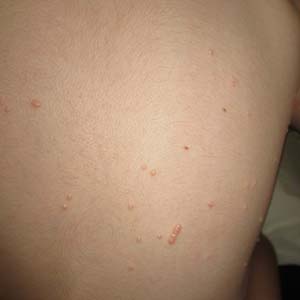 “Warts & Molluscum: Skin Viruses Gone Viral” (Don’t Be Rash: The Pediatric Dermatology Podcast 2025; Ep. 1)