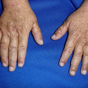 “The Itch that Rashes: The Diagnostic Approach to Atopic Dermatitis (Eczema),” Don’t Be Rash: The Pediatric Dermatology Podcast: S2025, Episode 4