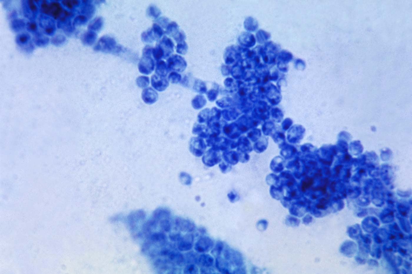 Don't Get Down in the Dumps: Understanding Yeast's Role in Diaper Candidiasis
