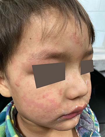 Child with Measles virus