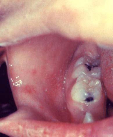 Child with Measles virus interior mouth