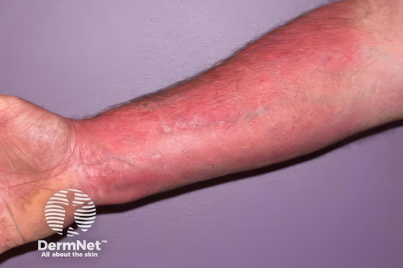 Red itchy forearm. Topical Steroid Withdrawal: Separating FACT from Online FRENZY