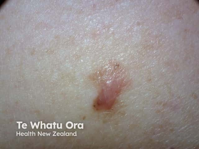Dermnet_www.dermnetnz.org/topics/melanoma/, Dermnet_www.dermnetnz.org/topics/superficial-spreading-melanoma, Diagnosis_melanoma, Icd10_c43, Melanoma, Sctid_55320002, Tumour