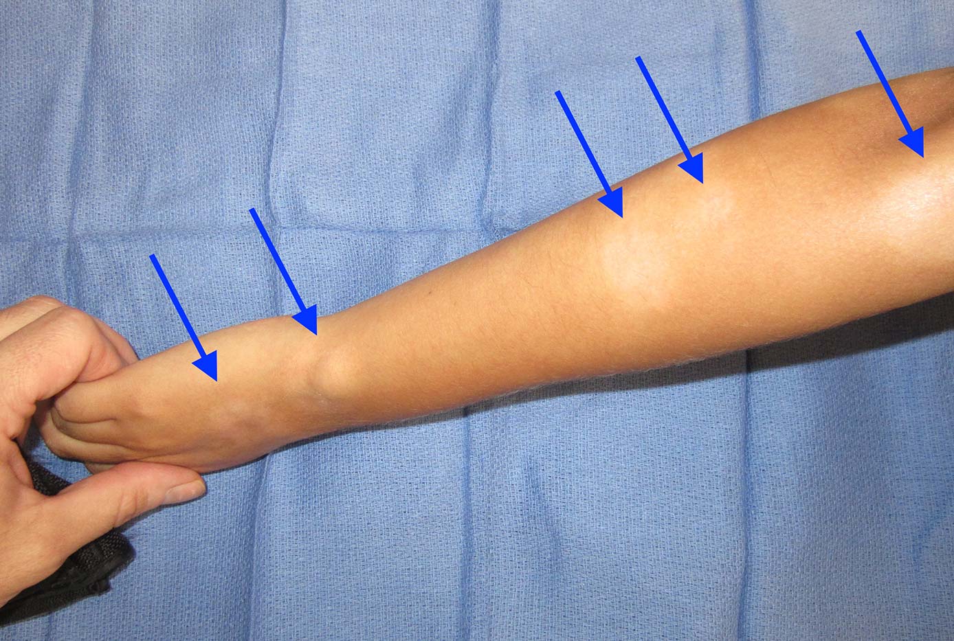 About Eczema/Atopic Dermatitis