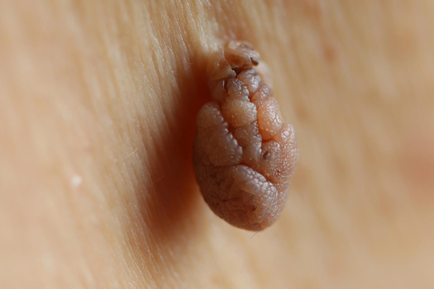 Dr. Scholl’s Skin Tag Removal Product: A Real “Foot in the Mouth” for Responsible Skin Care