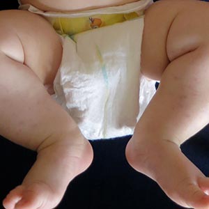 Don’t Be Rash: The Pediatric Dermatology Podcast: Y2026, Episode 1 “Down in the Dumps: The Approach to Diagnosing, Treating, and Preventing Diaper Dermatitis”
